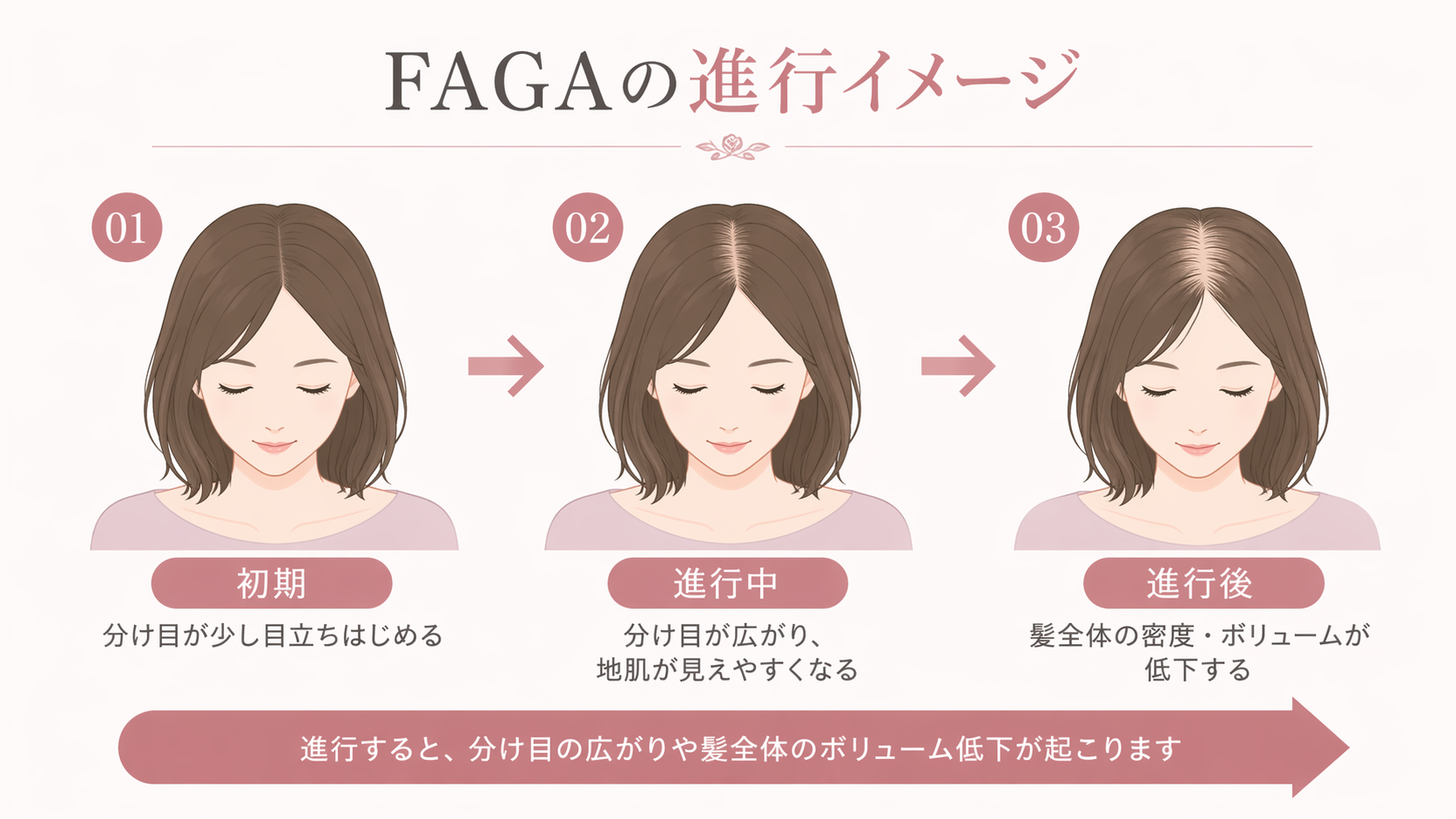 FAGA（女性の薄毛）の進行イメージ